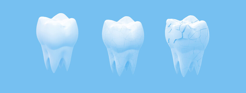 Why Do Humans Have Weak Teeth? 1 Tooth Cracking