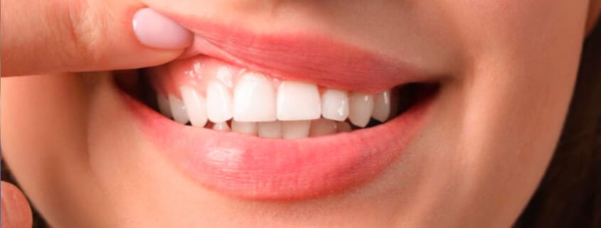 Smile Gum Line Disease