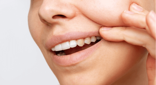 Dark-Teeth-Treatment-Img