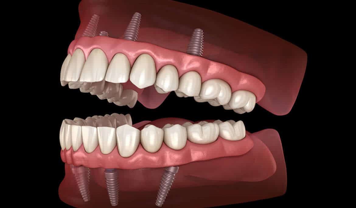 Hybrid Dental Inplant