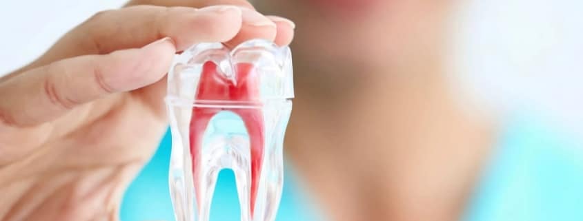Root Canal Treatment