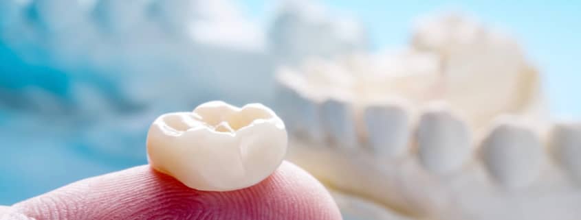 Cerec Crown On Dentist'S Fingertip