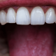 Close Up Of Healthy Canine Teeth