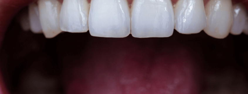 Unlocking The Secrets Of The Human Mouth: How Many Teeth Do Humans Have? 9 Close Up Of Healthy Canine Teeth Human Teeth Numbers How Many Teeth Should You Have How Big Is A Human Tooth Molar Teeth Child'S Baby Teeth How Many Teeth Do Kids Have How Many Teeth Do We Gave How Many Teeth Without Wisdom How Many Teeth Without Wisdom Teeth Gigi Seri Gigi Taring Oleh Sebab Itu Apa Itu Gigi Seri