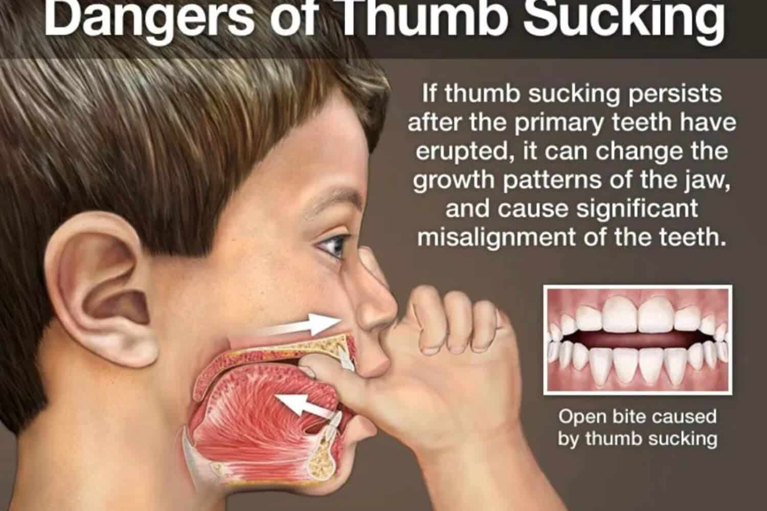 A Close Up Image Of Teeth With A Thumb In The Mouth Illustrating The Effects Of Thumb Sucking Teeth Habit And The Need To Break It Using Effective Strategies. 1