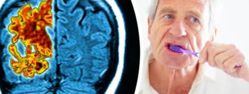 Man With Alzheimer’s Disease Brushing Teeth