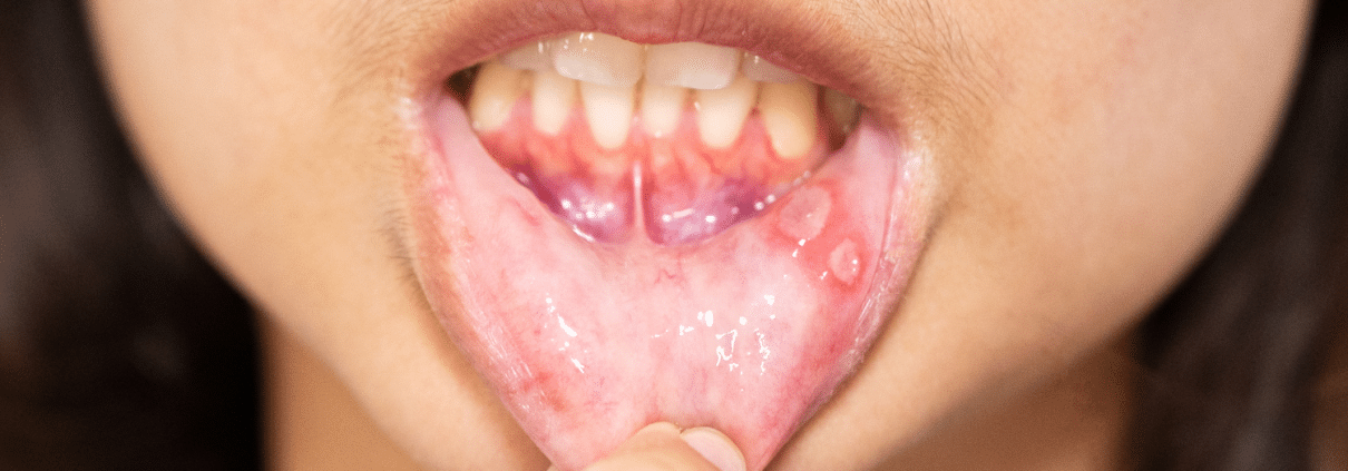 Photo Of A Person With Canker Sores On The Gumline