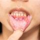 Photo Of A Person With Canker Sores On The Gumline