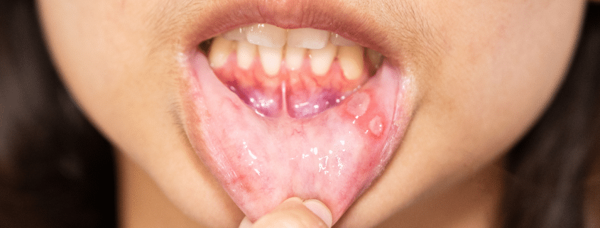 Understanding Why Your Gums Are White: Recognizing Symptoms And Seeking Treatment 17 Photo Of A Person With Canker Sores On The Gumline