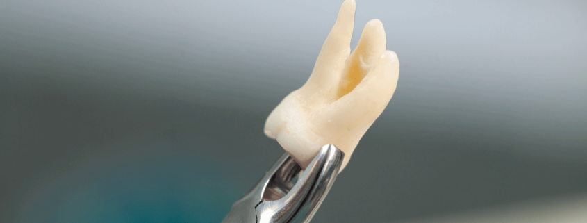 A Drawing Illustrating How Quickly An Infected Tooth Can Lead To Severe Health Issues.