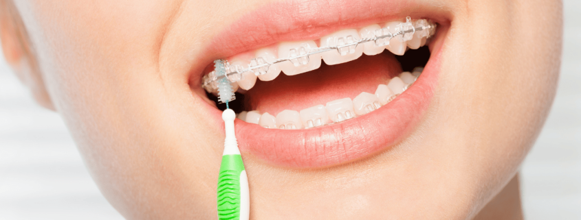 Should You Chew Gum With Braces Tips And Risks 19 What To Do If Gum Gets Stuck In Braces