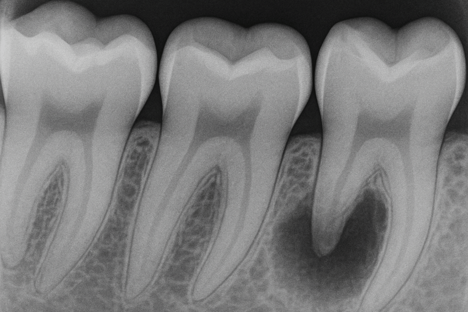 An X-Ray Image Displays An Infection Around The Root Of A Tooth, Indicating Potential Tooth Decay And The Need For Professional Dental Care.