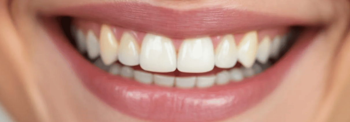 A Close-Up Image Captures A Person'S Natural Smile, Highlighting The Slight Variations In Tooth Color, Which May Indicate Mild Tooth Discoloration Or Yellowing Teeth.