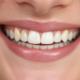 A Close-Up Image Captures A Person'S Natural Smile, Highlighting The Slight Variations In Tooth Color, Which May Indicate Mild Tooth Discoloration Or Yellowing Teeth.