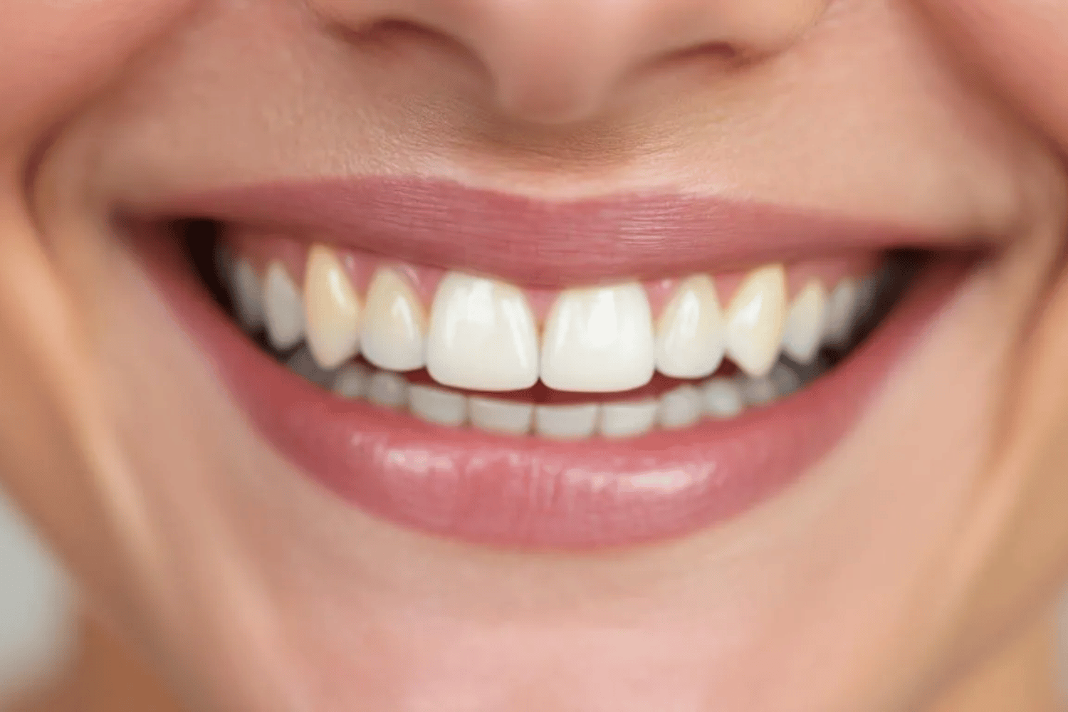 A Close-Up Image Captures A Person'S Natural Smile, Highlighting The Slight Variations In Tooth Color, Which May Indicate Mild Tooth Discoloration Or Yellowing Teeth.