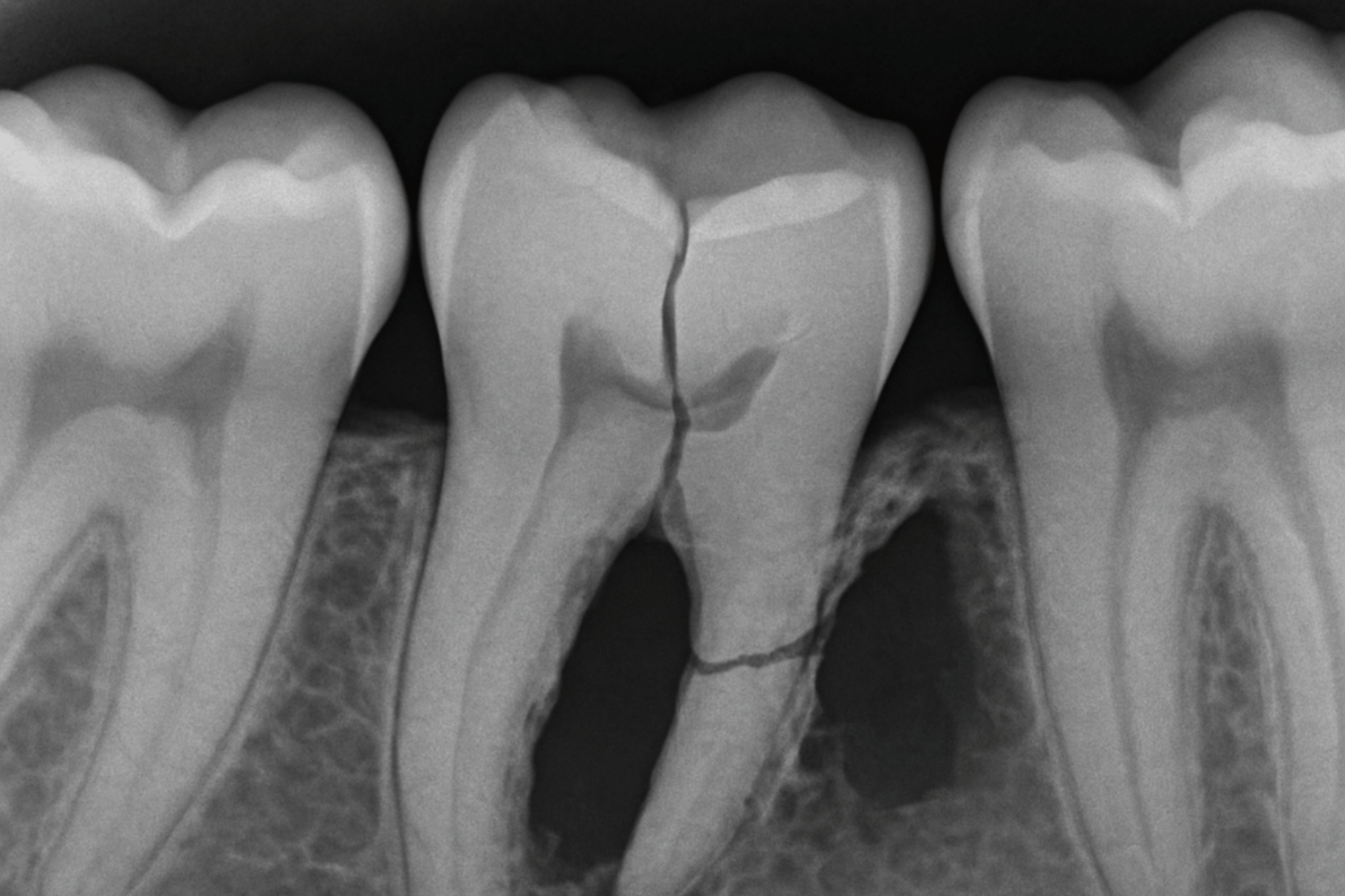 The X-Ray Image Reveals Significant Bone Loss Surrounding An Untreated Broken Tooth, Highlighting The Potential Dental Issues Such As Infection And Tooth Loss That Can Arise If A Cracked Tooth Is Left Untreated. This Image Serves As A Reminder Of The Importance Of Timely Treatment To Maintain Oral Health And Prevent Further Damage.