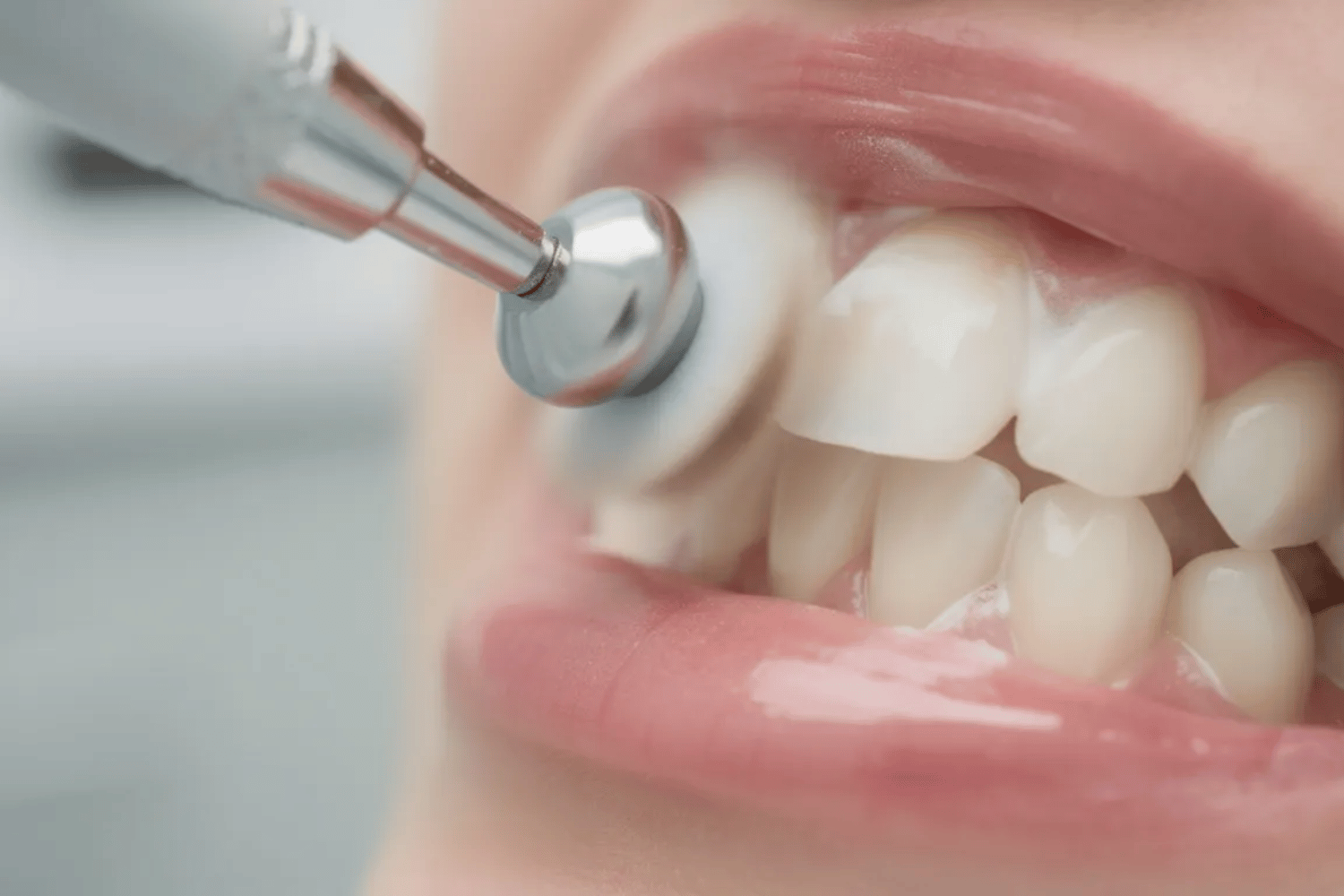 A Close-Up Image Shows A Dental Hygienist Using A High-Powered Electric Polishing Tool On A Patient'S Teeth, Gently Rotating To Remove Plaque And Tartar During A Professional Teeth Cleaning. This Process Is Essential For Maintaining Optimal Oral Health And Preventing Gum Disease.